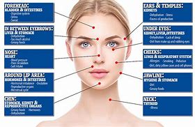 Image result for Hormonal Spots Face Mapping