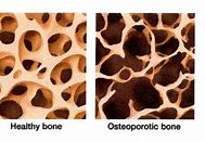 Image result for Normal Bone Density Chart