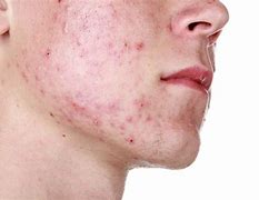 Image result for acne
