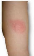 Image result for Mosquito Bites Allergic Reaction