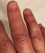 Image result for Rotting Finger