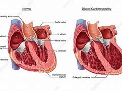 Image result for Dilated Cardiomyopathy