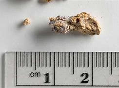 Image result for Average Size of Kidney Stone