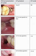 Image result for Granulation Tissue in Tooth Socket