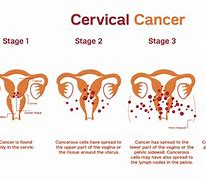 Image result for HPV Cervical Lesions