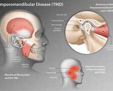Image result for TMJ Joint Pain