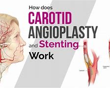 Image result for Carotid Angioplasty