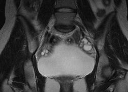 Image result for Bilateral Ovarian Dermoid Cysts