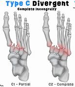 Image result for Lisfranc Fracture