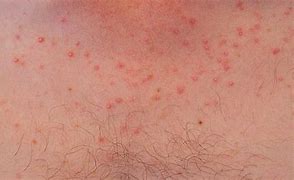 Image result for Yeast Folliculitis