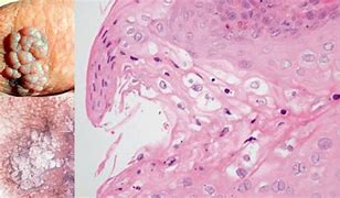 Image result for Pointed Condyloma