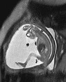 Image result for Anencephaly Radiograph