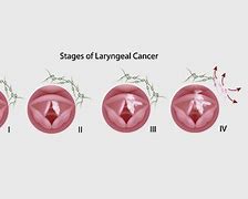 Image result for Beginning of Throat Cancer