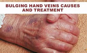 Image result for Sudden Bulging Veins in Hands