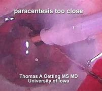 Image result for Paracentesis Position