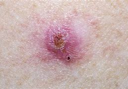 Image result for Untreated Basal Cell Skin Cancer