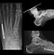 Image result for Second Metatarsal