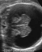 Image result for Holoprosencephaly vs Hydrocephalus Ultrasound