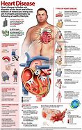 Image result for Heart Disease