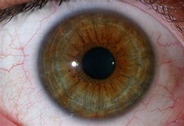 Image result for Yellow Ring around Eyes