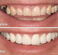 Image result for Smile Makeover Before and After