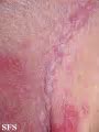 Image result for White Genital Warts