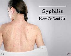 Image result for Woman with Syphilis