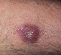 Image result for Kaposi Sarcoma HIV Skin Rash