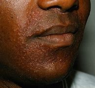 Image result for Fungal Rash On Black Skin