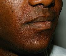 Image result for Skin Eruptions Face