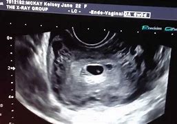 Image result for Ultrasound at 6 Weeks Pregnant