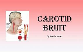 Image result for Carotid Artery Bruit