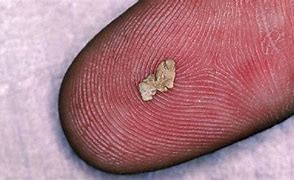 Image result for 5 Millimeter Kidney Stone