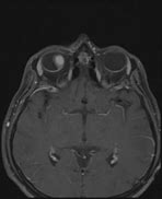Image result for Choroidal Melanoma MRI