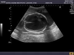 Image result for Mild Hydranencephaly Ultrasound