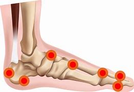 Image result for Bone Spurs Ankle Treatment