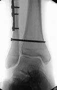 Image result for Fake Broken Ankle