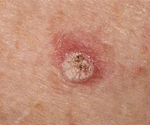 Image result for Cutaneous Papilloma