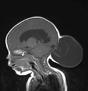 Image result for Posterior Encephalocele