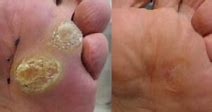 Image result for Corn Wart Treatment