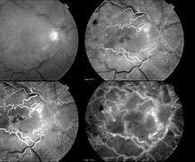 Image result for Retinal Hole with Fluid Cuff