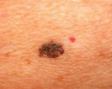 Image result for What Does Melanoma Look Like