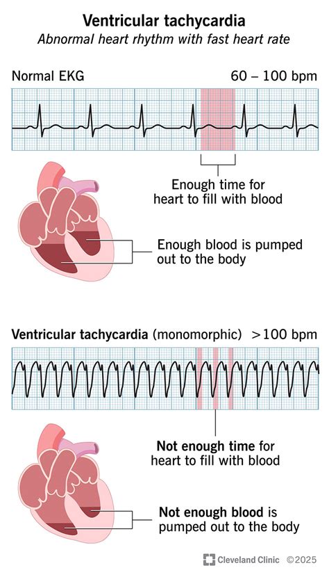 Image result for Ventricular Rhythms