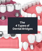Image result for Types of Dental Bridge ES