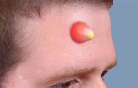 Image result for Disgusting Pimples Popping