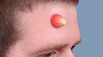 Image result for World's Most Biggest Pimple