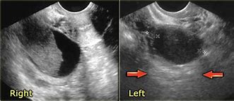 Image result for 10 Cm Cyst On Ovaries Ultrasound