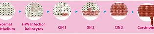 Image result for HPV Cervical Lesions