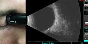 Image result for Ultrasound Eye Probe