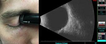 Image result for Eye Ultrasound